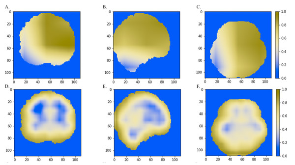 The comparisons of discriminative regions heatmaps in horizontal (x = 50), sagittal (y = 50), and coronal (z = 50) views of the brain MRI.