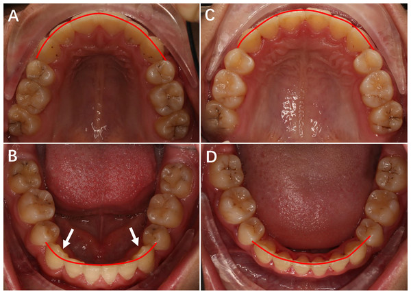 The upper and lower occlusal pictures of patients treated with Roth prescription and Chinese prescription appliance.