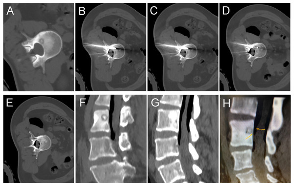 A 35-year-old female with intermittent low back pain for more than six months.