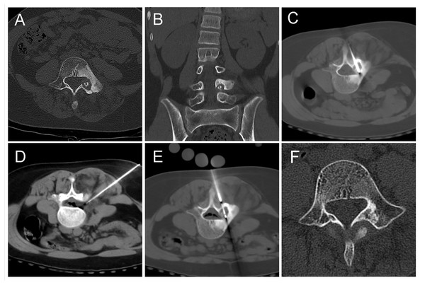 An 11-year-old girl with low back pain, predominantly at night.