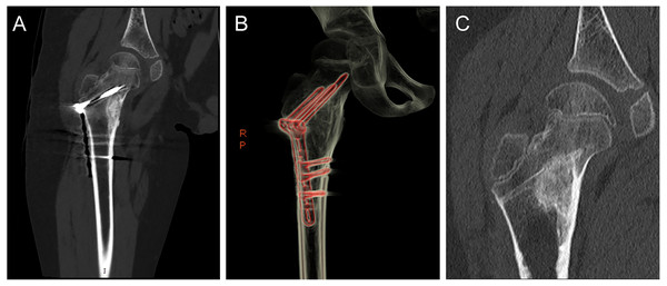 A 9-year-old boy with an osteoid osteoma of the right proximal femur who underwent surgical focal resection followed by bone grafting and internal fixation with plate screws.