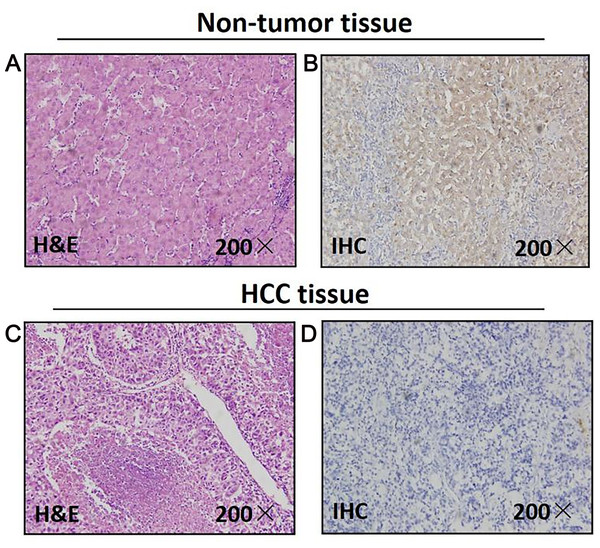 Mapk10 protein expression in HCC specimens shown by immunohistochemistry.