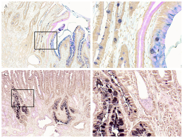 Acid mucus phenotypes in the lesion adjacent to GC.