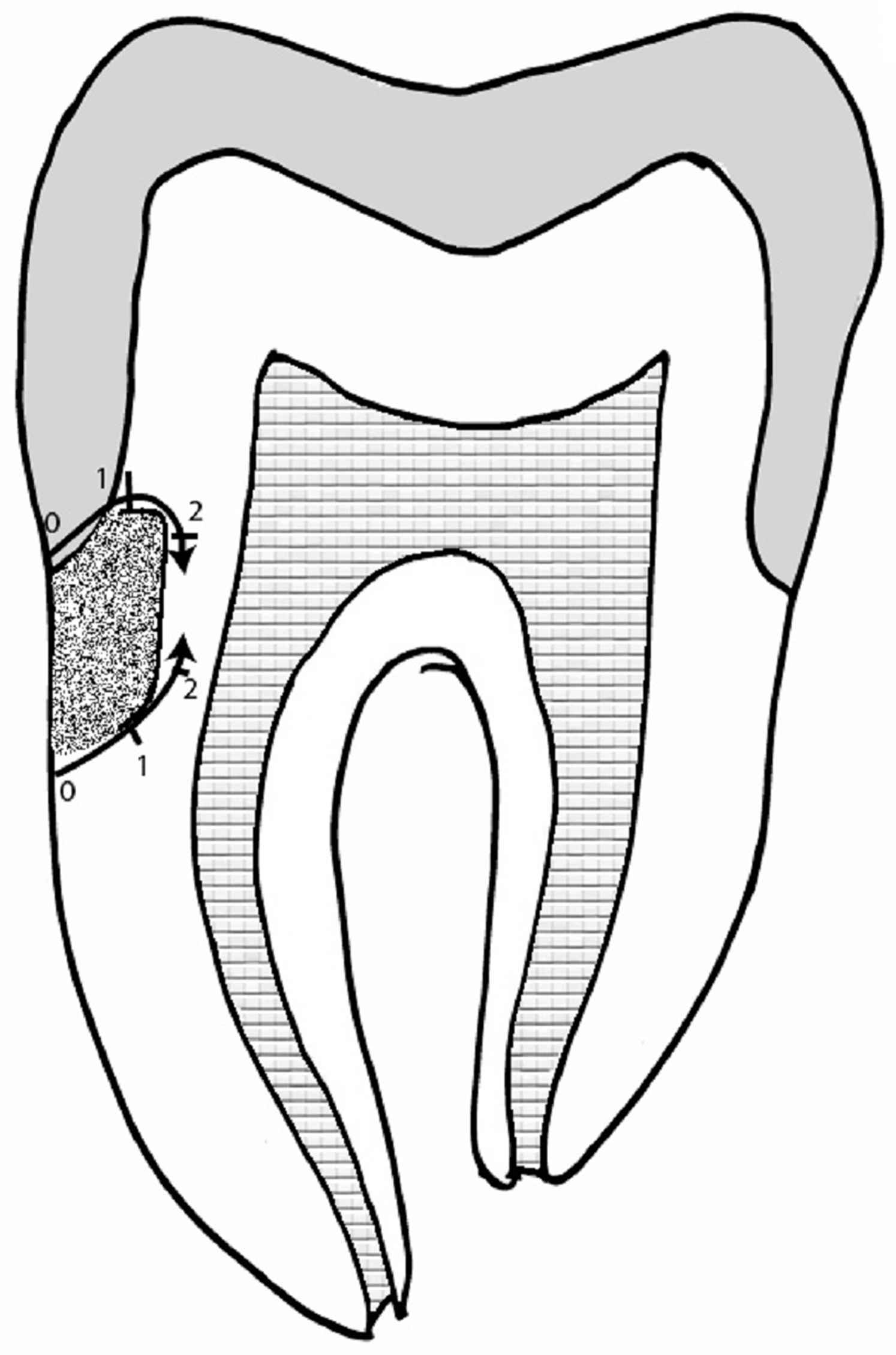 Comparison Of Microleakage Between Different Restorative Materials To ...