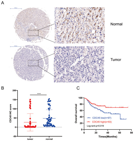 CDC45 protein expression and prognostic implications in the TMA of HCC.