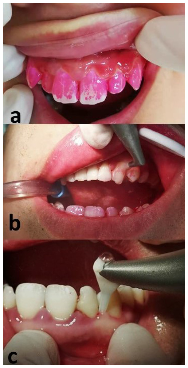 Influence of periodontal treatment on blood microbiotas a clinical trial PeerJ image