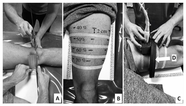 Thigh marking procedures (A and B) and ultrasound images acquisition (C). Probe guide (indicated by white arrow) (D).