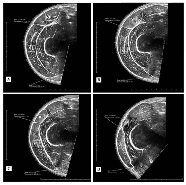Ultrasound images and cross-sectional areas (CSA) at 40% (A); 50% (B), 60% (C), and 70% (D) of femur length. Rectus femoris (RF) and vastus lateralis (VL).