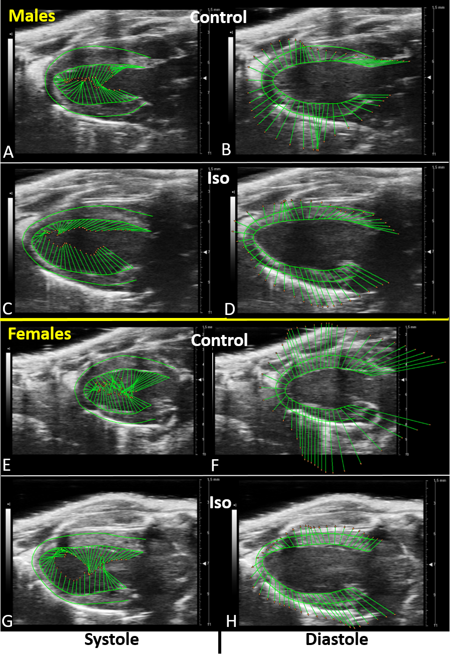 2-D echocardiography showing severe global hypokinesia and left