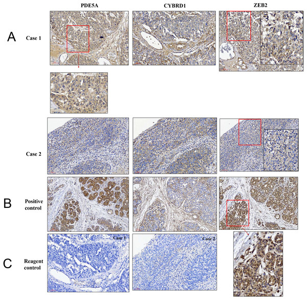 Illustration of histopathological analysis of sections from surgical resected human UTUC tissue.