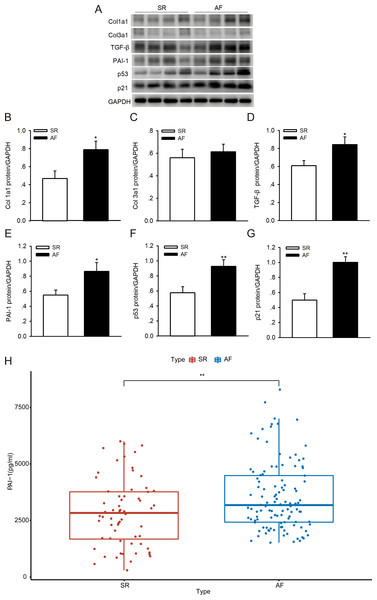 PAI-1 and p53 levels in patients with sinus rhythm (SR) and atrial fibrillation (AF).