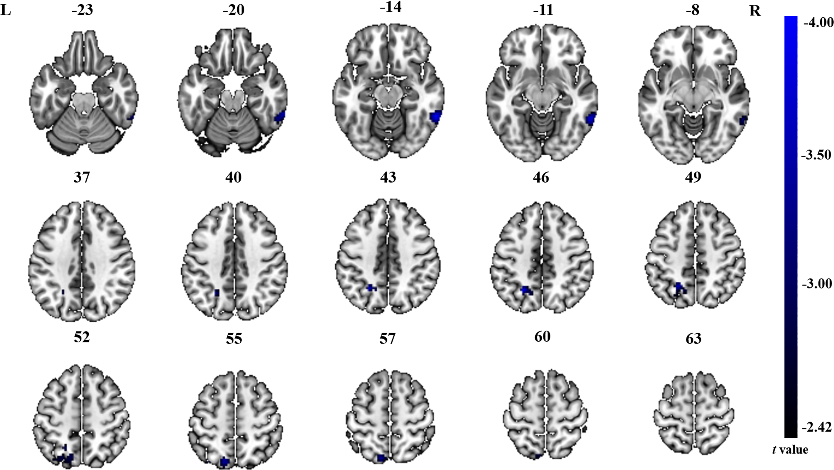 Alterations in brain structure and function in patients with osteonecrosis  of the femoral head: a multimodal MRI study [PeerJ]