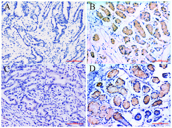 Immunohistochemical staining for ERCC6 and ERCC8 expression in GC and its paired pan-cancerous normal tissues.