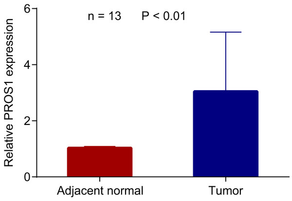 PROS1 expression in PTC and normal group using RT-qPCR.