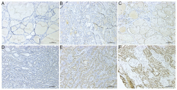 Microscope images showing PROS1 expression of IHC in PTC and normal control tissues (magnification: 200×).