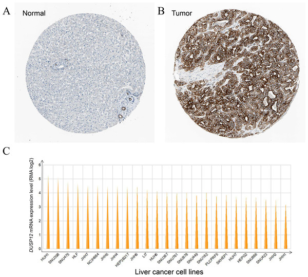 DUSP12 expression in liver-cancer tissues, normal liver tissues, and liver-cancer cell lines.