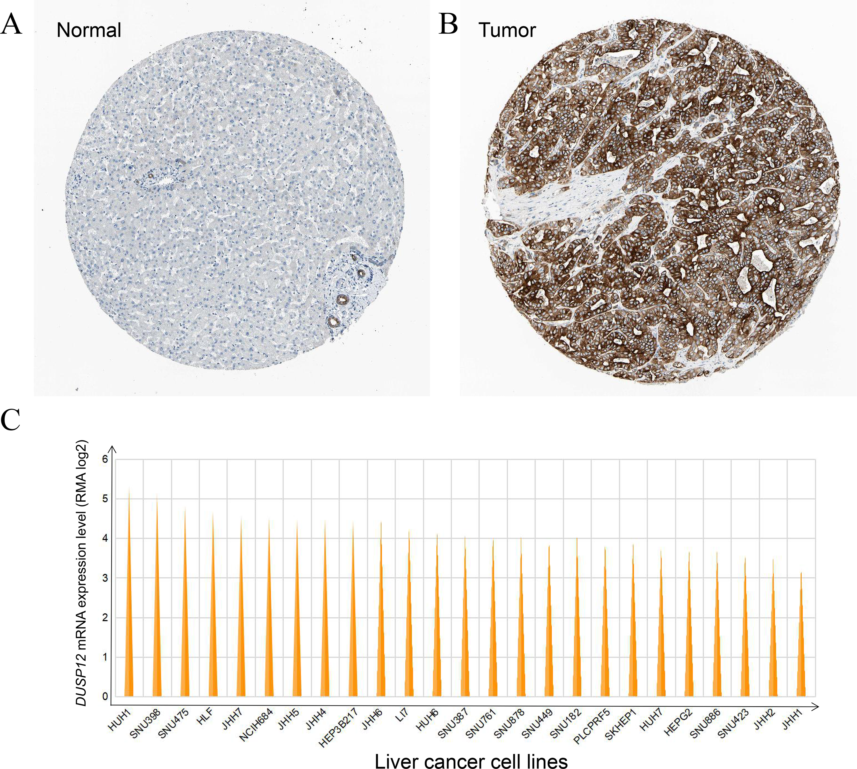 DUSP12 regulates the tumorigenesis and prognosis of hepatocellular 