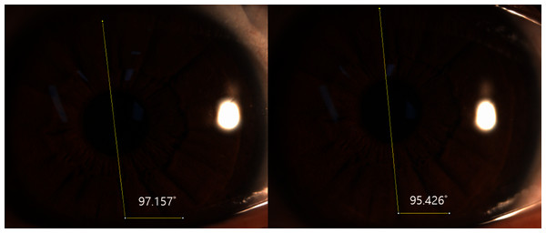 Ocular torsion of a left eye determined with ImageJ.