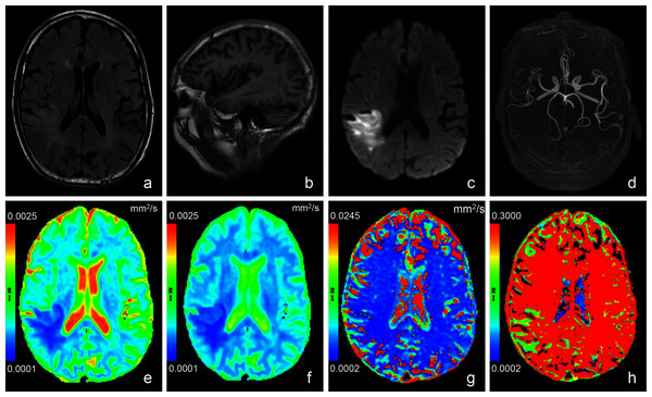 Images of a representative patient (male, 78 years old, lesion volume: 41.5 ml, time from stroke onset to MRI: 24 h, National Institutes of Health Stroke Scale on admission: 13, day-90 modified Rankin Scale: 3) with acute stroke in the r.