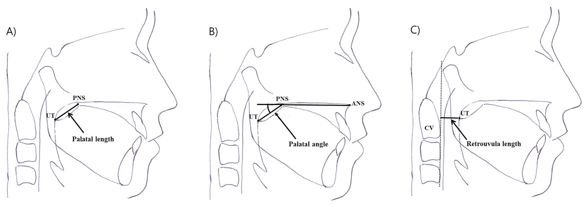 Positional changes in the uvula tip after adenotonsillectomy in ...