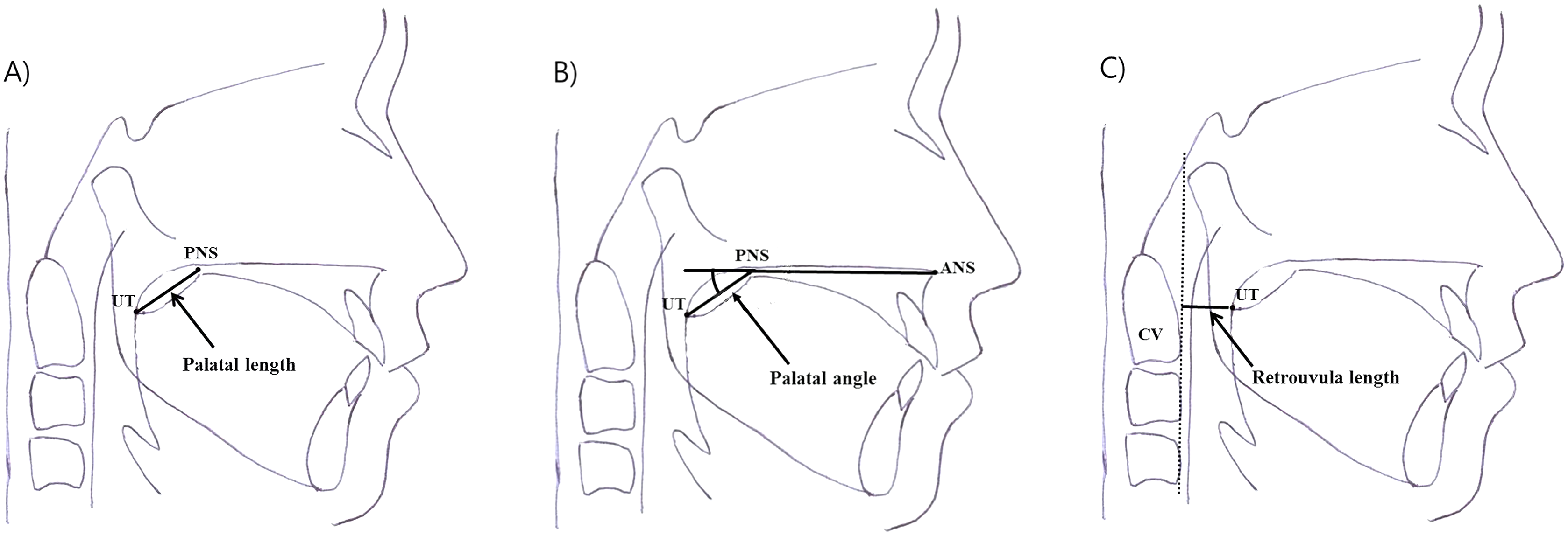 Positional Changes In The Uvula Tip After Adenotonsillectomy In 