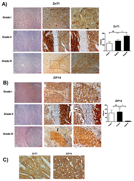 The evaluation of ZnT1 and ZIP14 protein expressions in Grade I, Grade II and Grade III HCC tissues by IHC.
