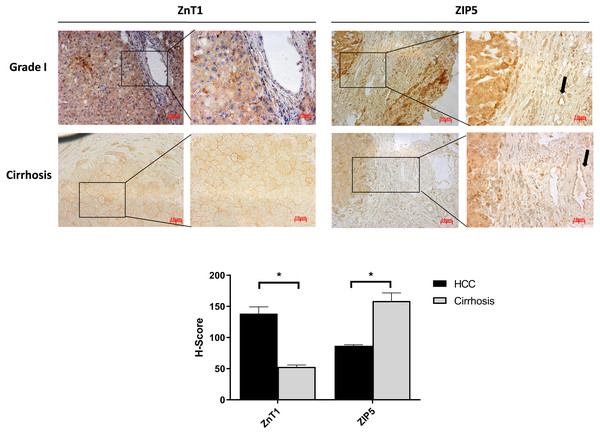 The evaluation of Znt1 and Zip5 protein expressions in cirrhotic and Grade I HCC tissue.