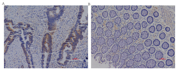 Representative IL20RA protein expression in CRC and adjacent normal tissues.