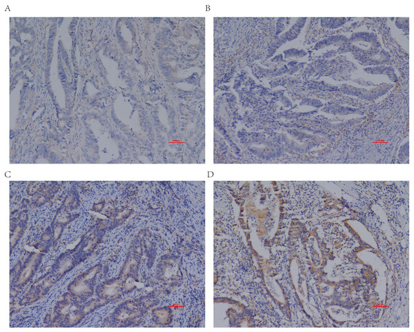 Differential IL20RA expression levels in CRC tissues.