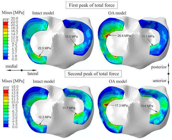 The contour plots of the von Mises stress on the proximal surfaces of the menisci.