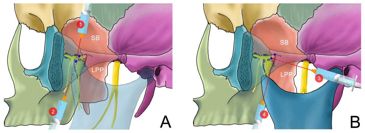 Application Of Ultrasound Guidance In The Oral And Maxillofacial Nerve Block Peerj 1881