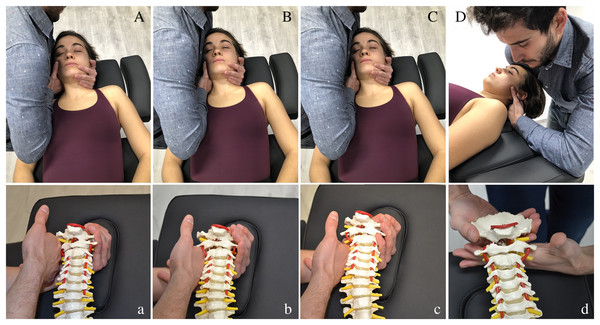 (Aa) C0-1 Traction manipulation in the resting position. Patient was in supine with neck in neutral position. The therapist gently cupped the patient’s chin with their hand while their arm was cradled around the head. The other hand placed the radial side of the index finger under the mastoid process and aligned the forearm in the line of drive pointing cranially. Then the therapist applied a cranial thrust41,20,8. (Bb) C1-2 Traction manipulation in the resting position. The same handling procedure was performed but the grip was relocated in the atlas vertebrae41,20,8. (Cc) C2-3 Traction manipulation in the resting position. The same handling procedure was performed but the grip was relocated in C3 vertebrae41,20,8. (Dd) C0-1 Dorsal mobilization. Patient was positioned in supine, with neck in neutral position. The therapist placed a hand dorsally at the level of the vertebral arch of C1 with the metacarpophalangeal and radial border of the index finger. The other hand was placed posteriorly under the occiput, with the shoulder positioned anteriorly on the patient’s forehead. The mobilization force was directed dorsally from the shoulder until the therapist felt a marked resistance, and then slightly more pressure was applied to perform a stretching mobilization46,34,40.