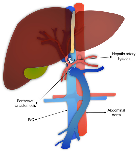 Portocaval anastomosis and hepatic artery ligation as a model of acute liver failure.
