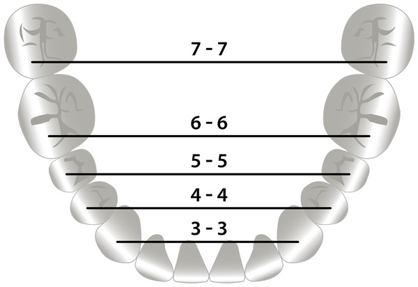 Mandibular transverse dental arch dimensions.