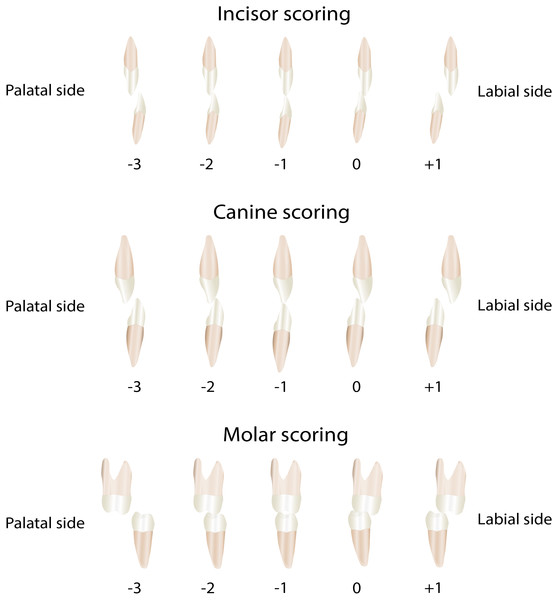 The Modified Huddart-Bodenham scoring of teeth pairs to determine the interarch relationship.