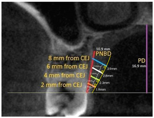 PMT, PNBD and PD measurement on the second molar tooth level image.