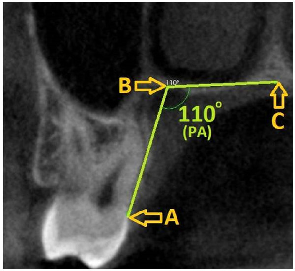 Palatal angle measurement and reference points on the second molar tooth level image.