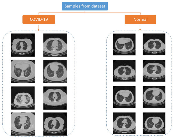 Samples of COVID-CTset images (Rahimzadeh, Abolfazl & Seyed, 2020).