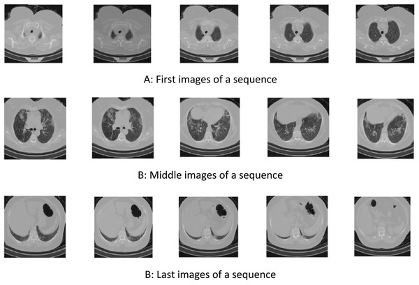 Samples of sequential COVID-CTset images (Rahimzadeh, Abolfazl & Seyed, 2020).