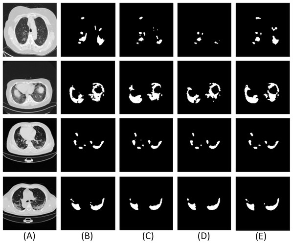 Experimental results of the improved dilation convolution and the traditional dilation convolution.