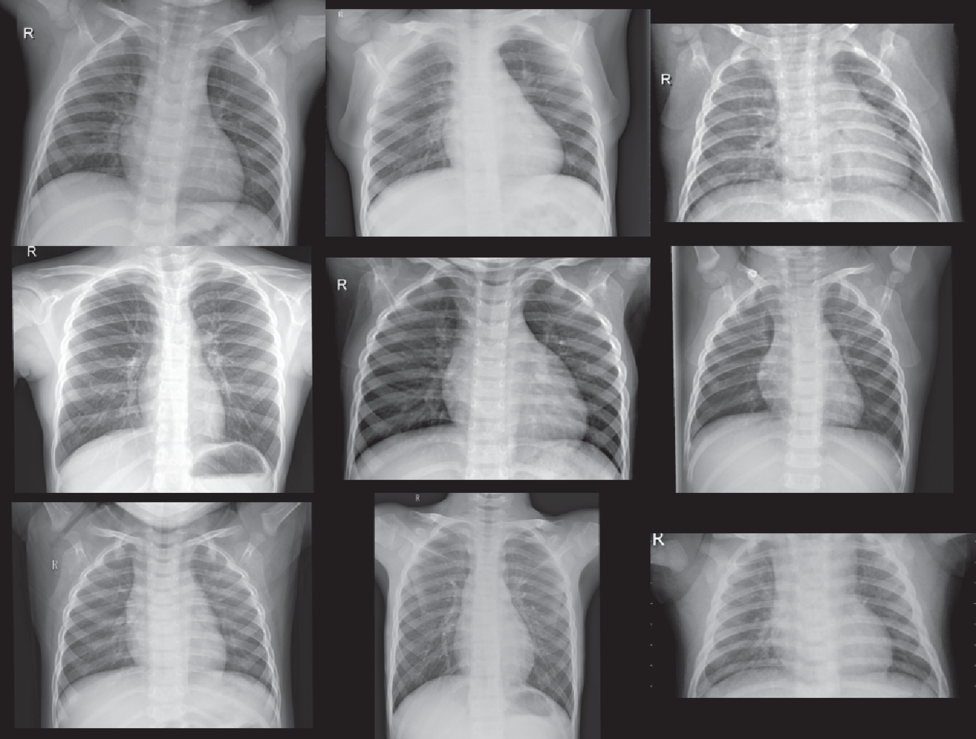 Synthetic COVID-19 CXR Dataset Dataset