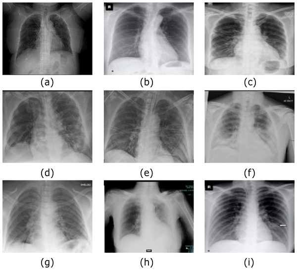 Samples of COVID-19 Cases (A–I) out of Dataset-2 from (Bachir (2020).