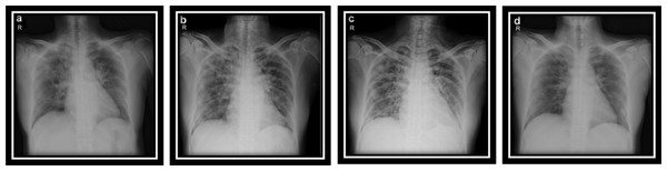 (A–D) CXR COVID-19 images of a 53-year-old patient with pneumonia after 10 days of infection.