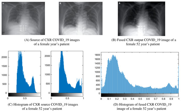Example of a female 52-year-old patient (P1) CXR COVID-19 image fusion.