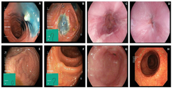Image samples of KASVIR dataset: (A) Dyed-Lifted-Polyp, (B) Dyed-Resection-Margin, (C) Esophagitis, (D) Normal-z-line, (E and F) Normal-Cecum, Polyps, (G) Normal-Pylorus, and (H) Ulcerative-Colitis.