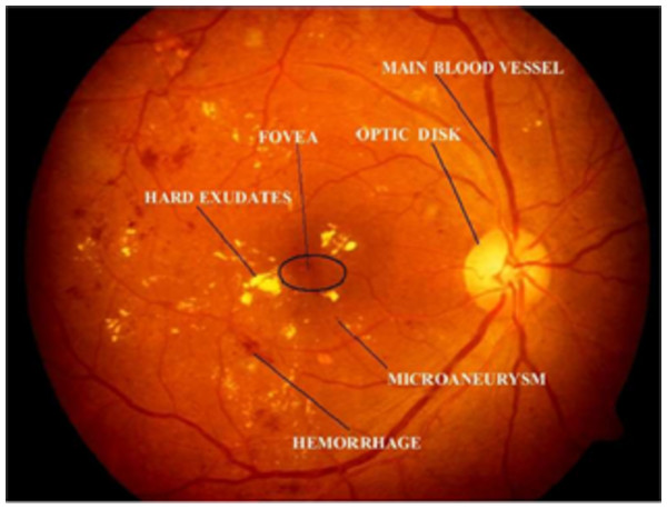 Illustration of retinal image features.