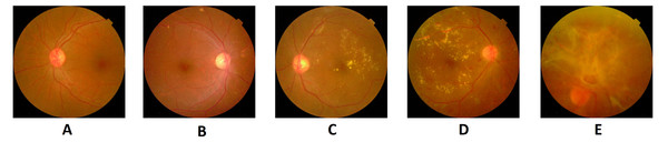 Five stages of diabetic retinopathy in fundus images: (A) without DR, (B) mild, (C) moderate, (D) severe, (E) PDR.