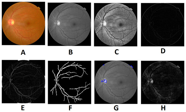 Preprocessed result of normal retina image: (A) input image, (B) green channel, (C) histogram enhanced, (D) filtered image, (E) after bottom hat transform, (F) after top hat transform, (G) blood vessels segmented, (H) contours enhanced.