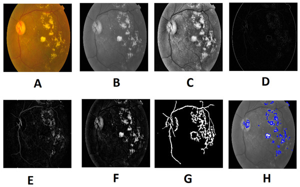 Preprocessed result of diabetic retinopathy image: (A) input image, (B) green channel, (C) histogram enhanced, (D) filtered image, (E) after bottom hat transform, (F) after top hat transform, (G) blood vessels segmented, (H) contours enhanced.