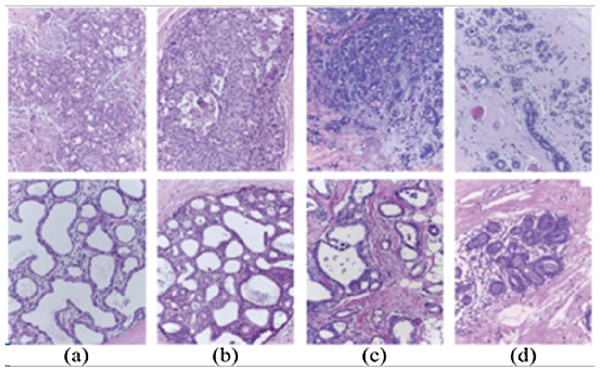 Examples of microscopic breast cancer histological images of ICIAR 2018 dataset: (A) benign, (B) in situ carcinoma, (C) invasive carcinoma, (D) normal.